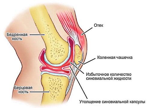 Основные причины, почему болит колено